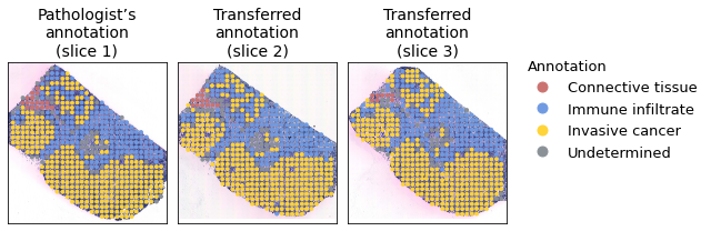 ../../_images/tutorials_breast_cancer_STitch3D_breast_cancer_clustering_and_downstream_9_0.png